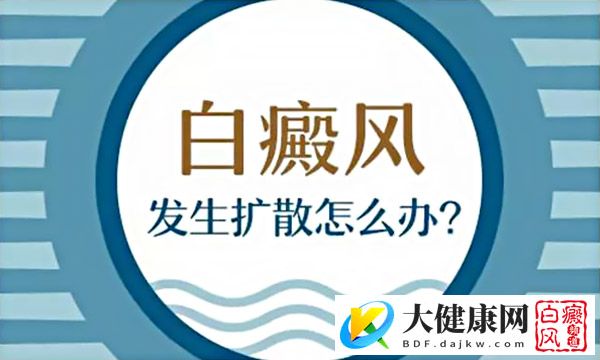 怎样做才能降低白癜风的扩散概率?